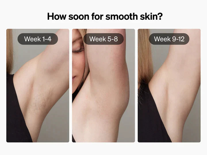 LaserSmooth™ - Long Lasting Hair Removal